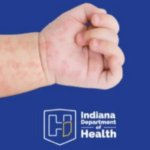 1029 measles